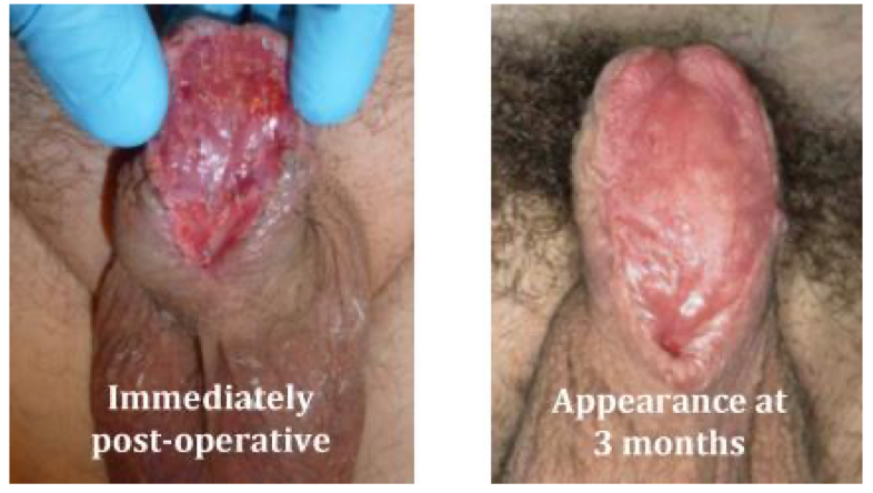 Urethroplasty 1st stage immediately post-operative and at 3 months
