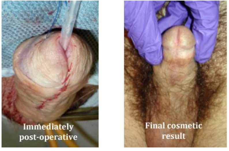 Urethroplasty 2nd stage immediately post-operative and final cosmetic result