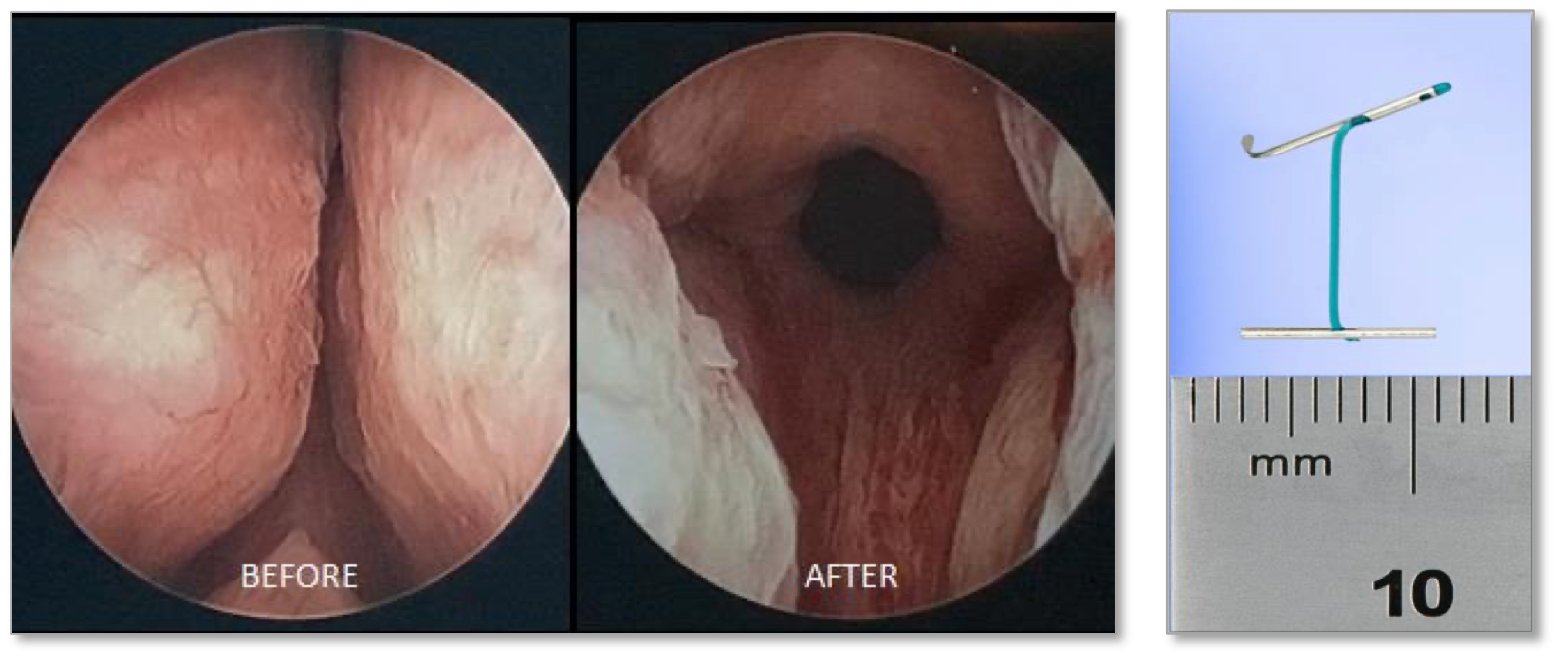 UroLift — before/after endoscopic views and implant device