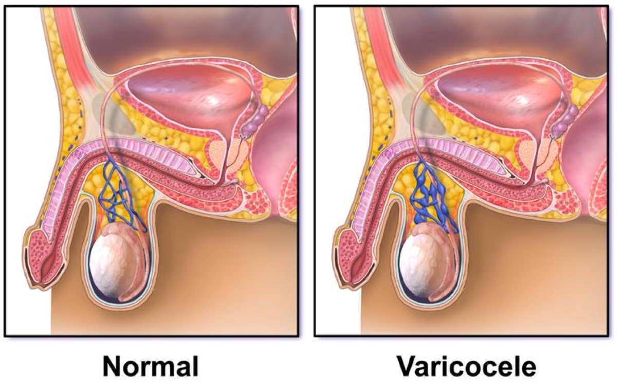 Normal anatomy compared with varicocele