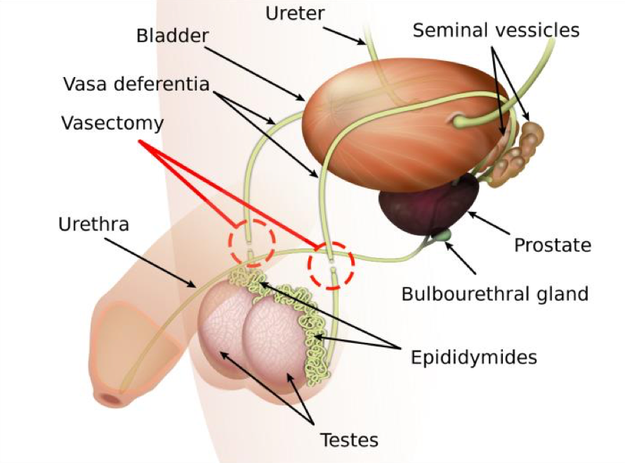 Vasectomy — division of the vas deferens