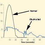 Diagnosis of Lower Urinary Tract Symptoms Resulting from Benign Prostatic Hyperplasia