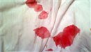 Blood in the semen (haematospermia)