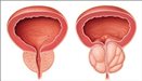 Prostate symptoms (bladder outlet obstruction)