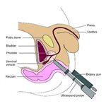 Transrectal Ultrasound & Prostatic Biopsy