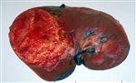 Renal Cancer MDT