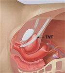 Vaginal Mesh for Stress Urinary Incontinence: Information for Healthcare Practitioners