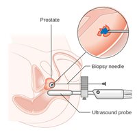 Maidstone Transperineal Prostate Biopsy (LATP) Workshop